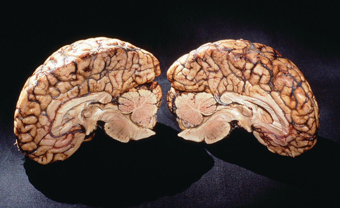 A photograph of the left and right midsagittal sections of a brain. The brain's inner structures are revealed, including the corpus callosum and third ventricle.