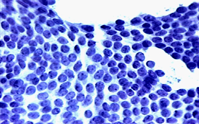 One of the cell images from which the Wisconsin Breast Cancer dataset was derived. (Image courtesy of Nick Street and Bill Wolberg.)
