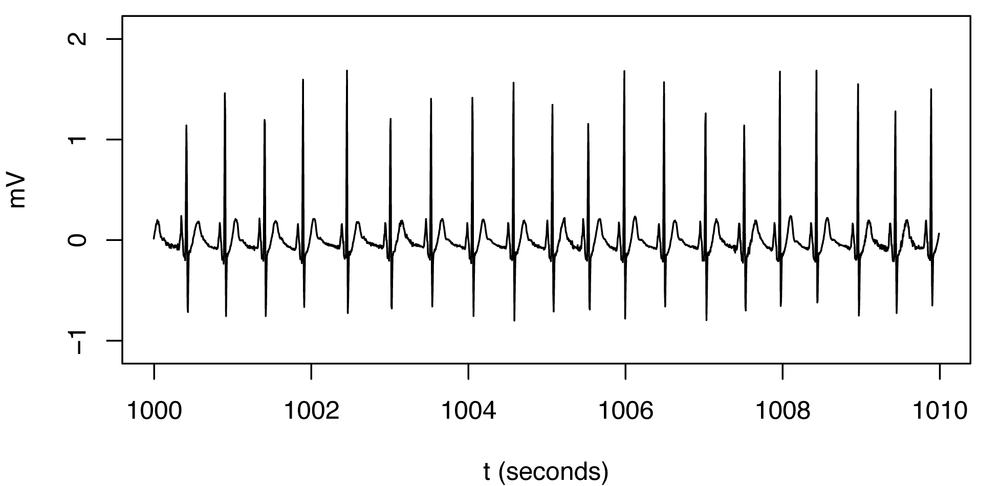 Normal heartbeat pattern recorded in an EKG. The spikes that had, in isolation, appeared to be anomalies relative to the horizontal curve are actually a regular and expected part of this normal pattern.