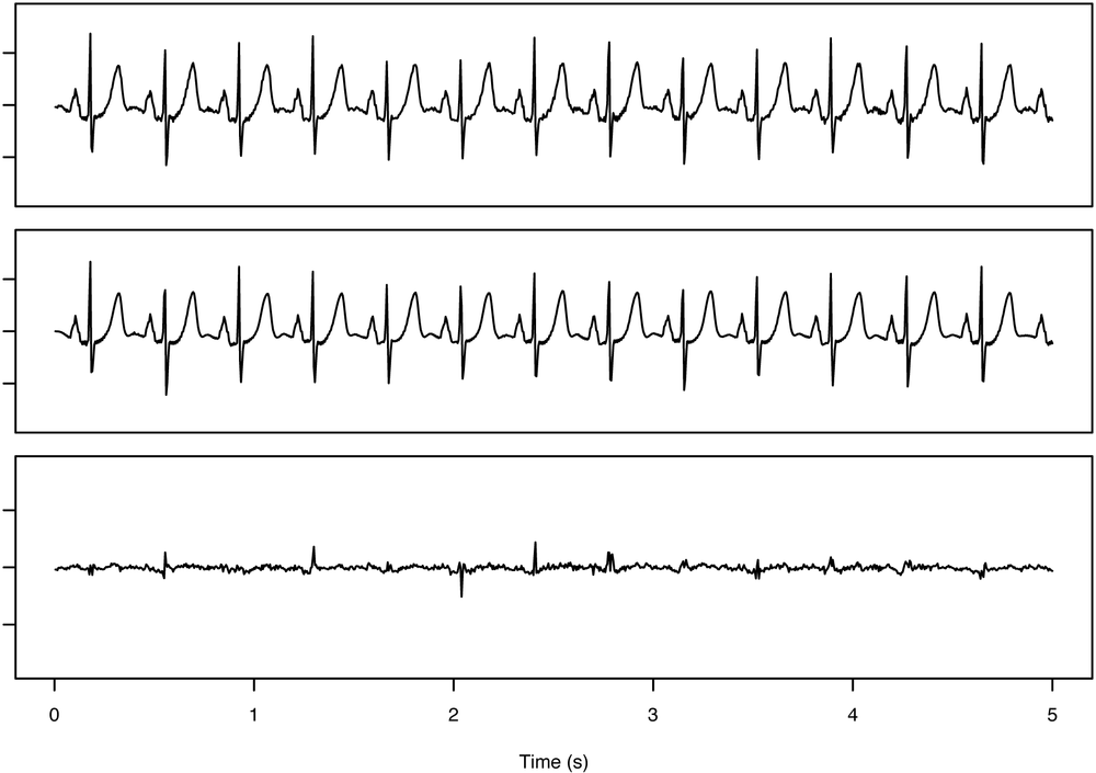 Reconstruction of normal pattern for heartbeats using windowing and clustering. The reconstruction error (bottom trace) for an EKG signal (top trace) is computed by subtracting the reconstructed signal (middle trace) from the original. Notice that the reconstruction error (bottom trace) is small and relatively uniform.