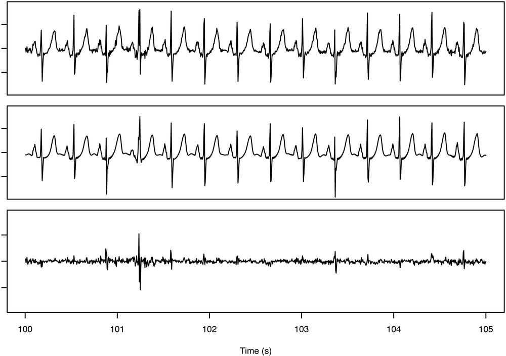 Reconstruction for a heart signal displaying anomalous behavior. Top trace is the original EKG signal. The bottom trace shows the reconstruction error that is computed by subtracting the reconstructed signal (middle trace) from the original. Notice the spike in the error at just past 101 seconds. That error spike indicates that the reconstruction shown in the middle panel was unable to reproduce that section of the original signal shown at the top.