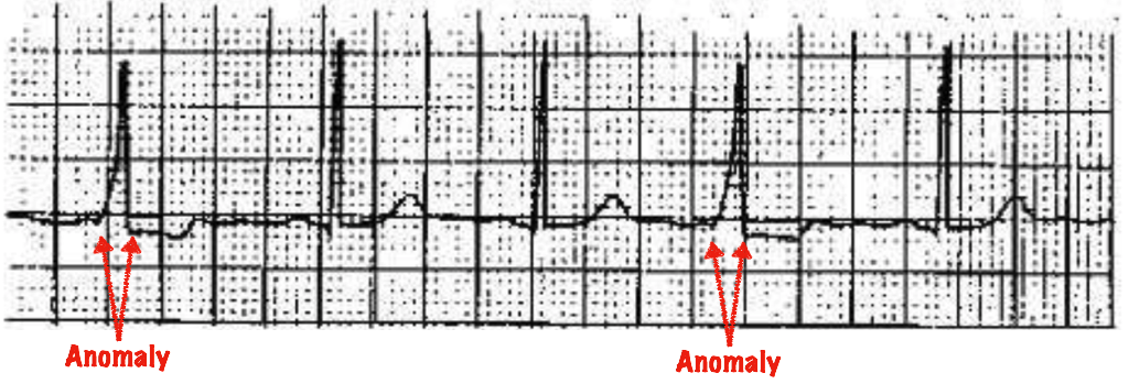 anomalies in a human heartbeat