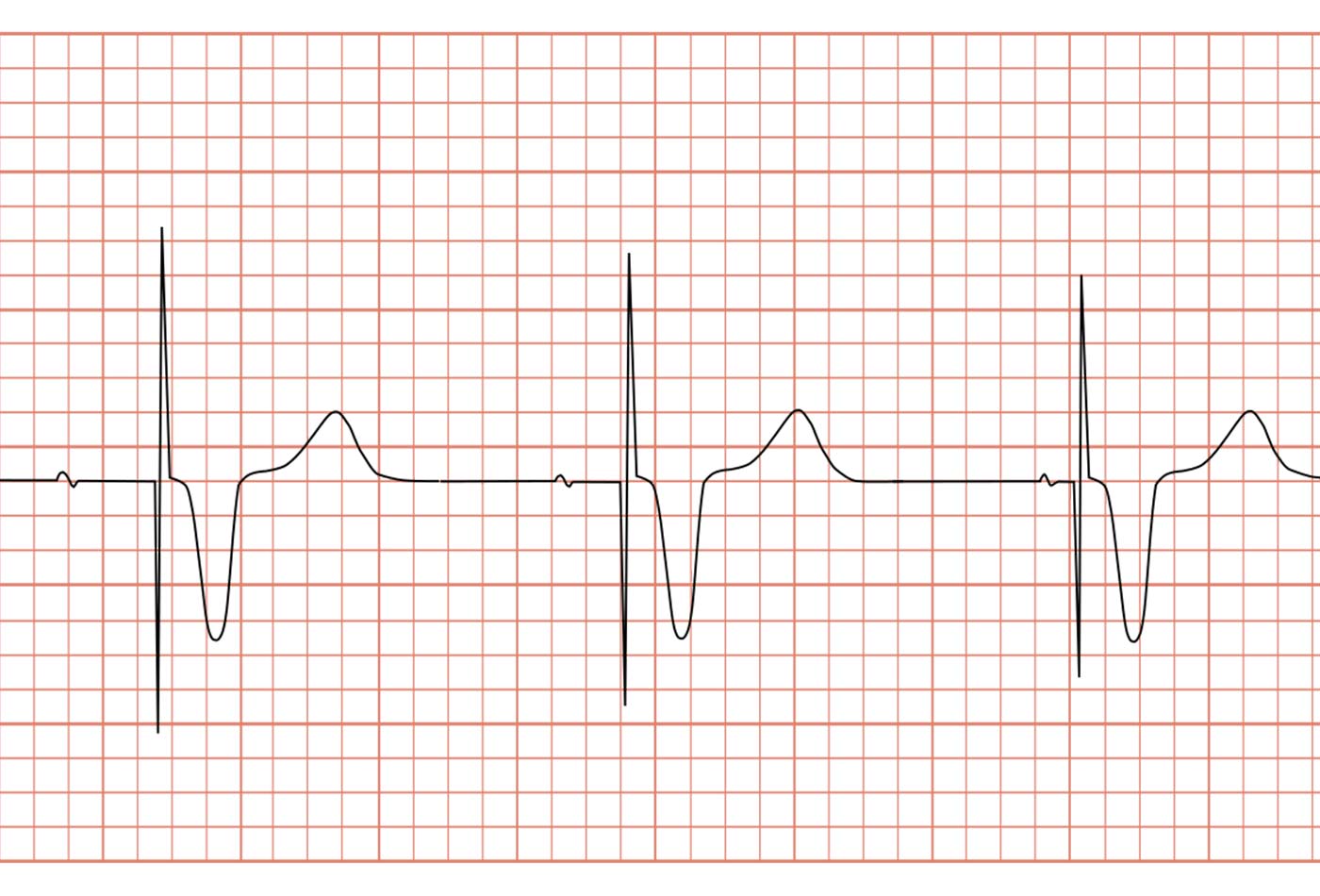 ECG pacemaker syndrome.